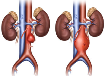 Mielec:   Bezpłatne badania w mieleckim szpitalu. Nie daj się tętniakowi aorty brzusznej!