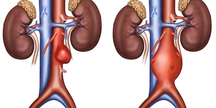 Mielec:   Bezpłatne badania w mieleckim szpitalu. Nie daj się tętniakowi aorty brzusznej!
