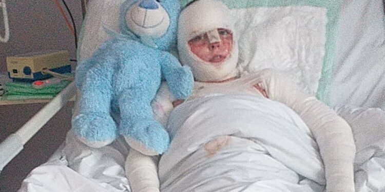 Turbia: Pomóżmy poparzonemu 14-letniemu Radkowi