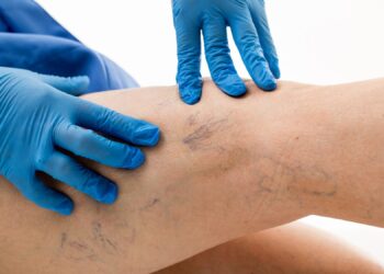 Stalowa Wola: Szpital Sanus uruchomił bezpłatne zabiegi usuwania żylaków laserem