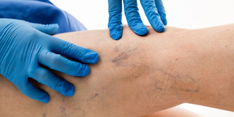 Stalowa Wola: Szpital Sanus uruchomił bezpłatne zabiegi usuwania żylaków laserem