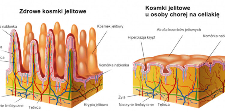 Sandomierz: 16 maja Międzynarodowy Dzień Celiakii
